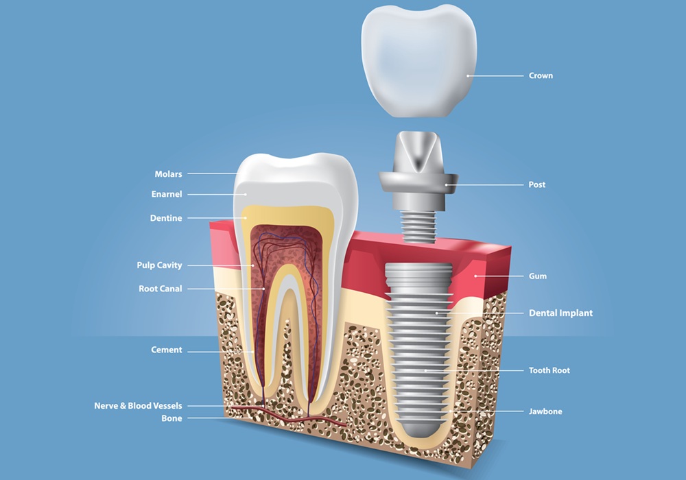 インプラント治療のイメージ