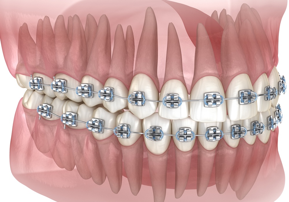 矯正歯科のイメージ