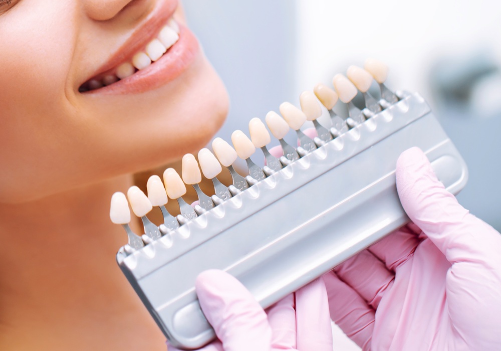 審美歯科のイメージ